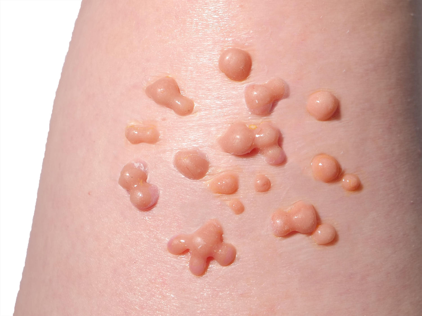 Silicone Boils Cluster Prosthetic – Realistic SFX Skin for Halloween & Film Makeup