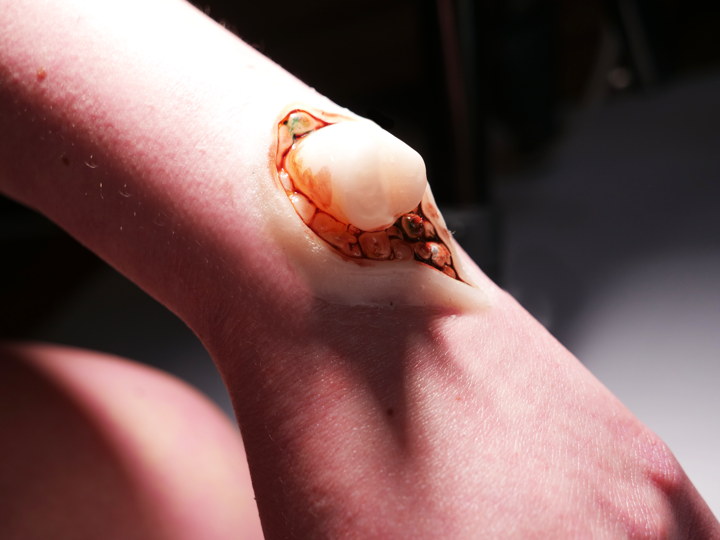 [Item 003] Broken Bone Prosthetic