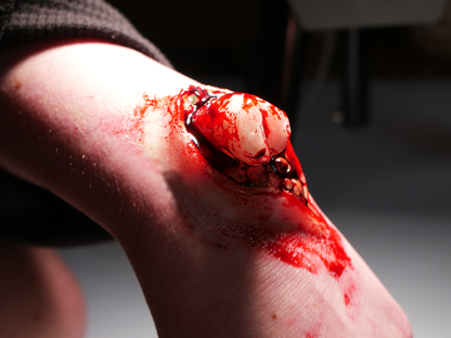[Item 003] Broken Bone Prosthetic
