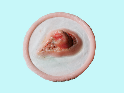 [Item 003] Broken Bone Prosthetic