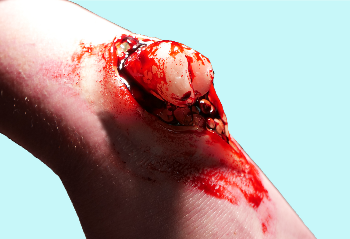 Emerging Broken Bone Prosthetic