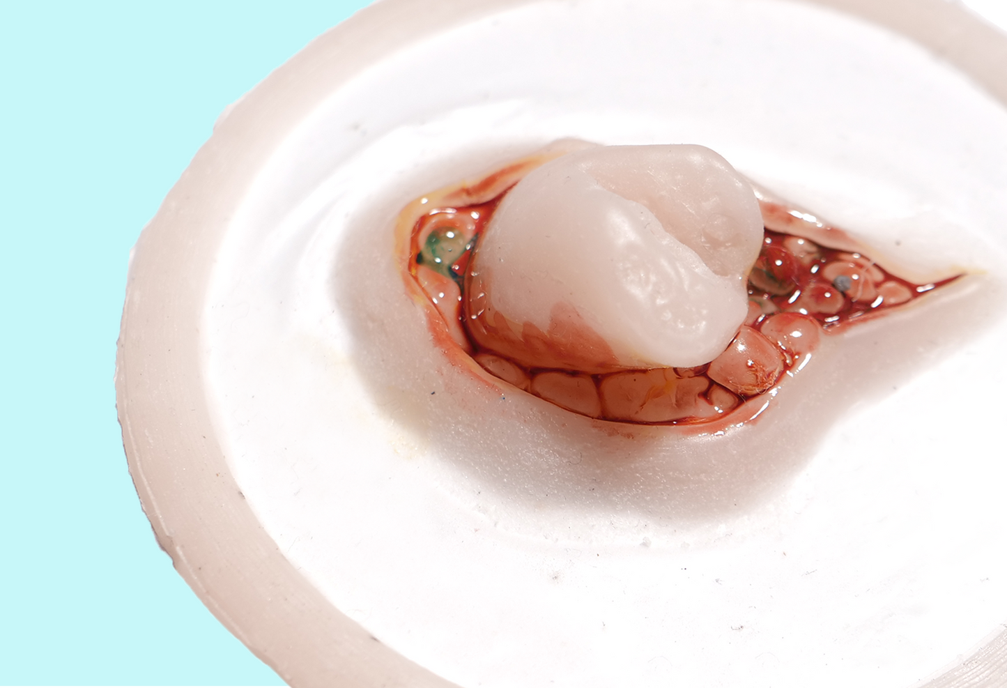 Emerging Broken Bone Prosthetic