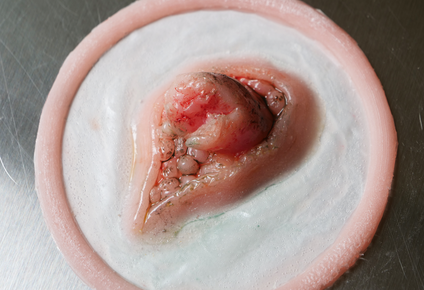 Emerging Broken Bone Prosthetic