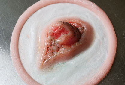 Emerging Broken Bone Prosthetic