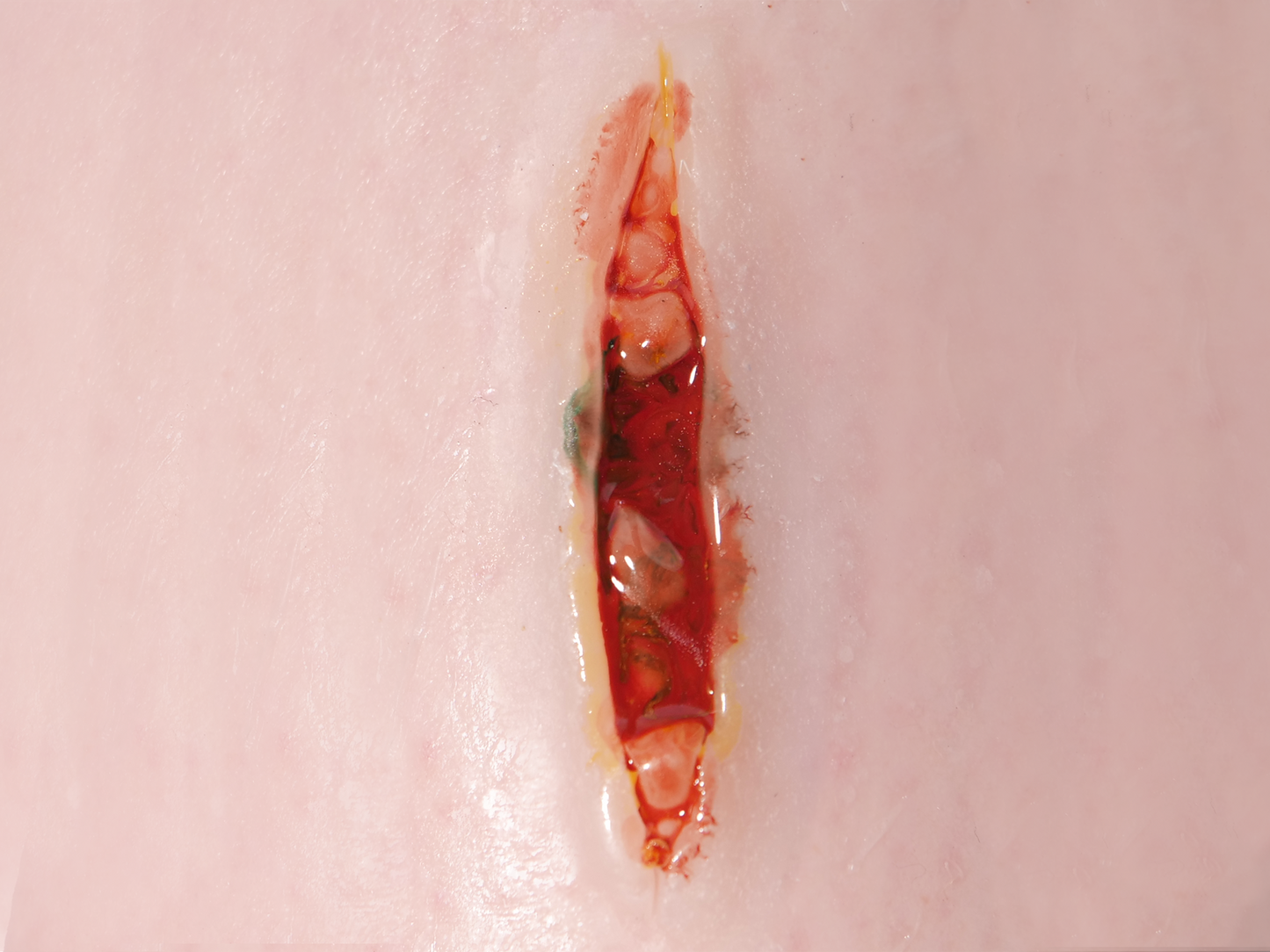Deep Laceration Prosthetic