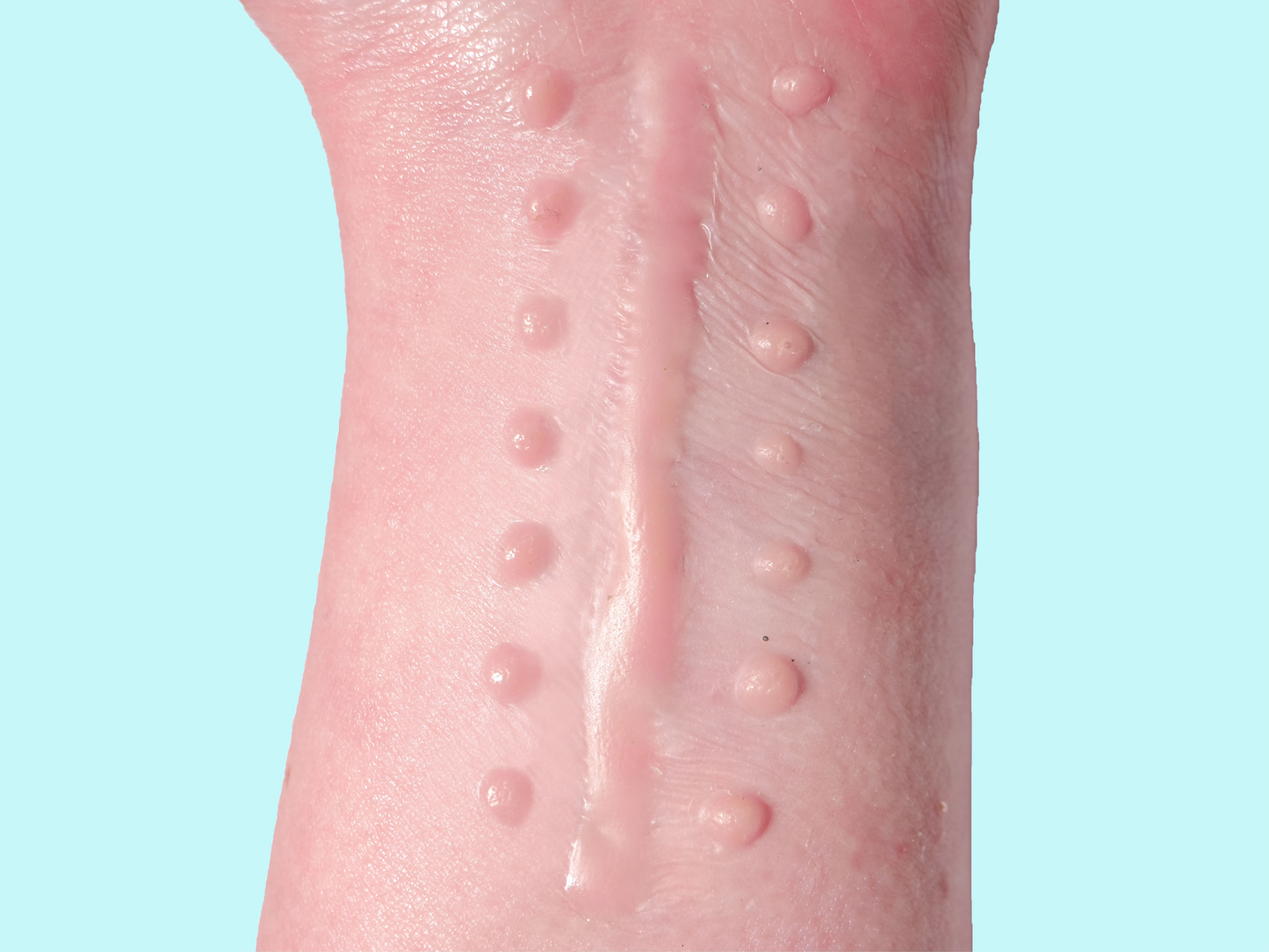 Suture Scar Prosthetic