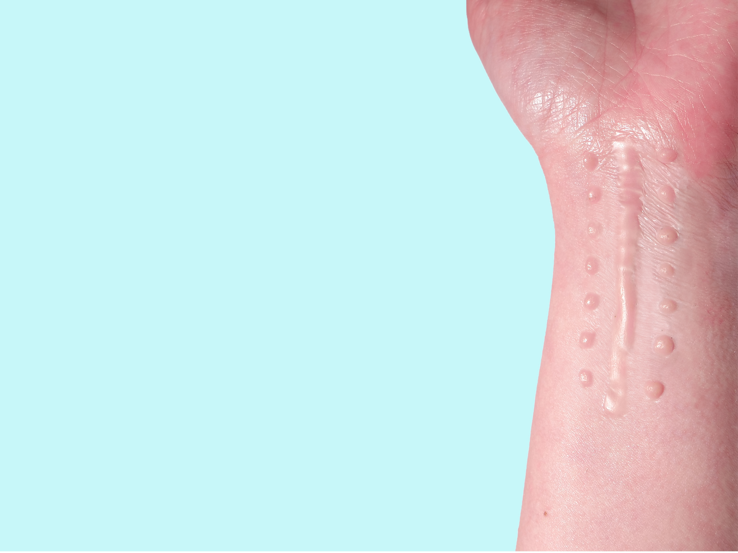 Suture Scar Prosthetic