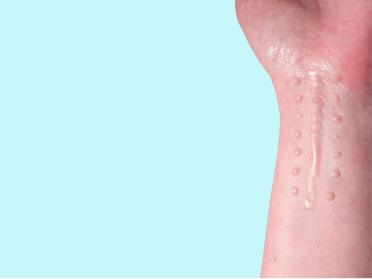 Suture Scar Prosthetic