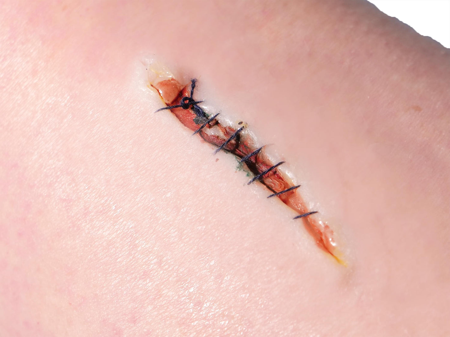 [Item 021: Incision Unit S-9] – Minor Laceration, Sutured