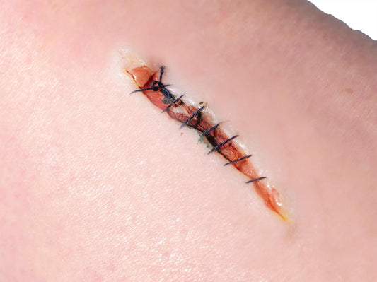 [Item 021: Incision Unit S-9] – Minor Laceration, Sutured