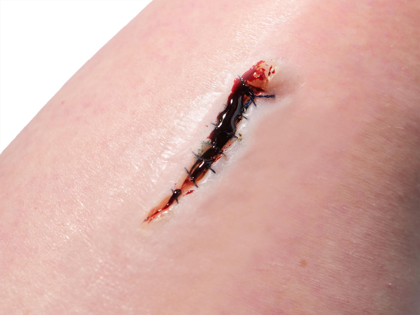 [Item 021: Incision Unit S-9] – Minor Laceration, Sutured
