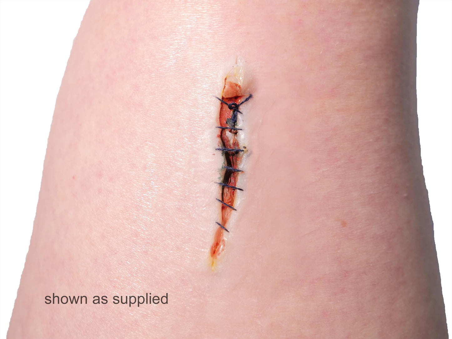 [Item 021: Incision Unit S-9] – Minor Laceration, Sutured