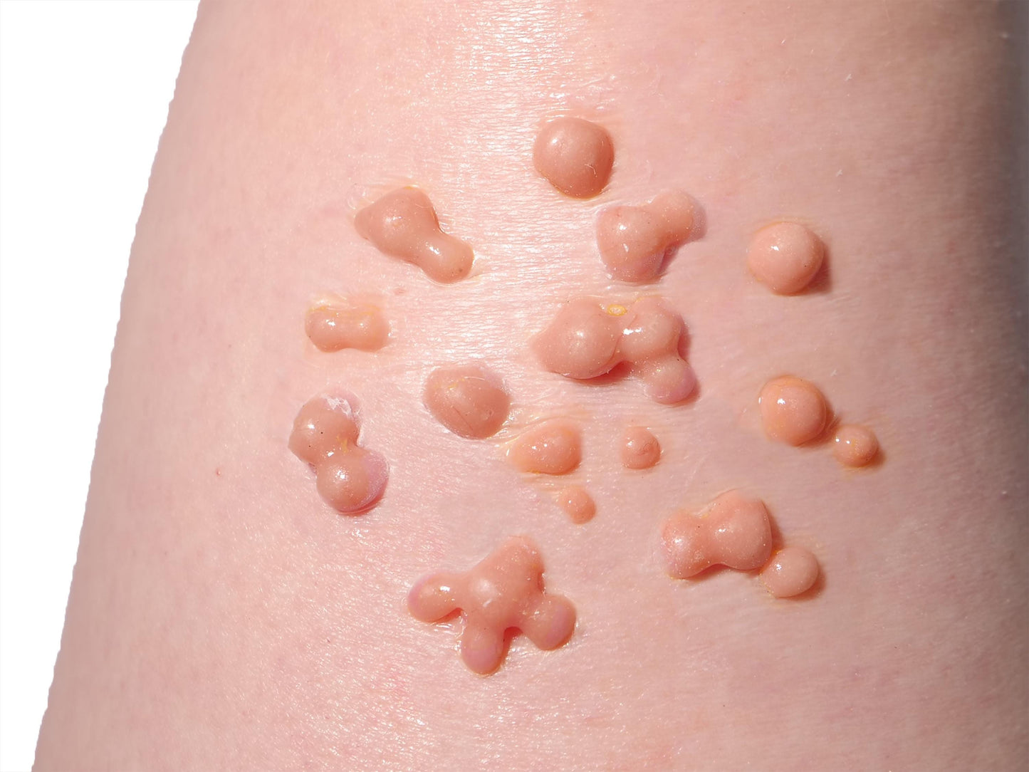 [Item 008: Dermal Bloom] – Cluster B6 Infection Prototype