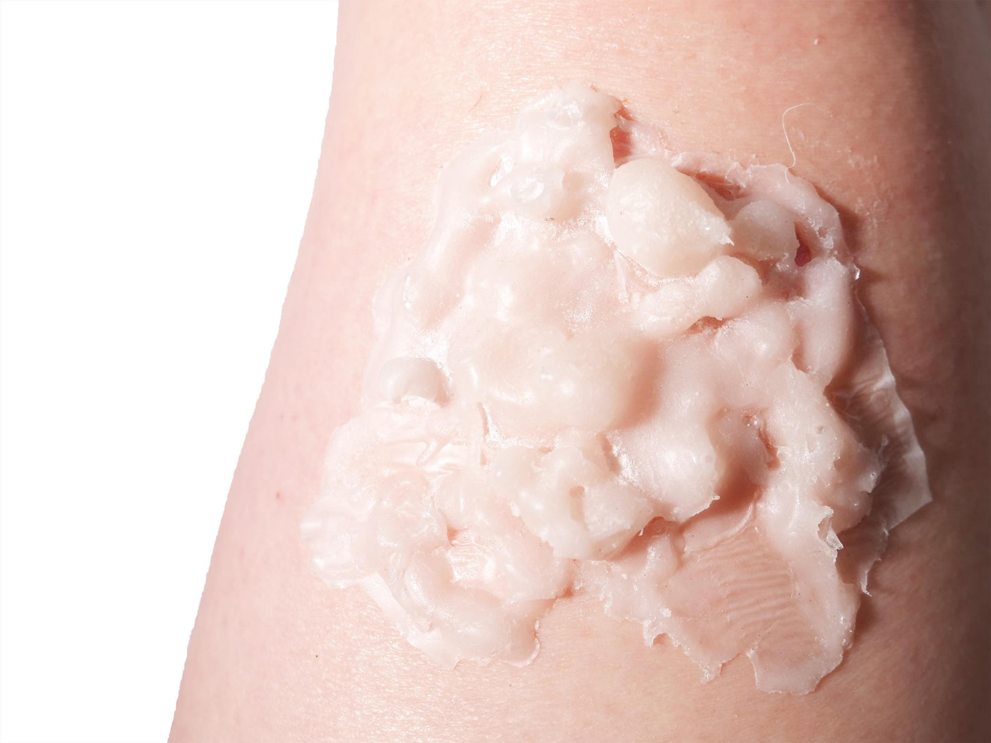 [Item 033: Dermal Failure Z-3] – Thermal Compromise Zone