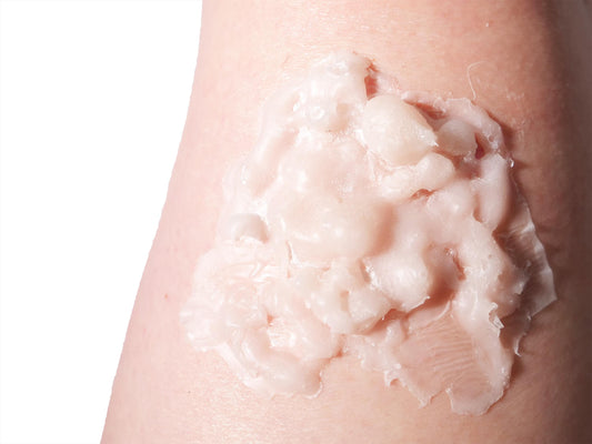 [Item 033: Dermal Failure Z-3] – Thermal Compromise Zone
