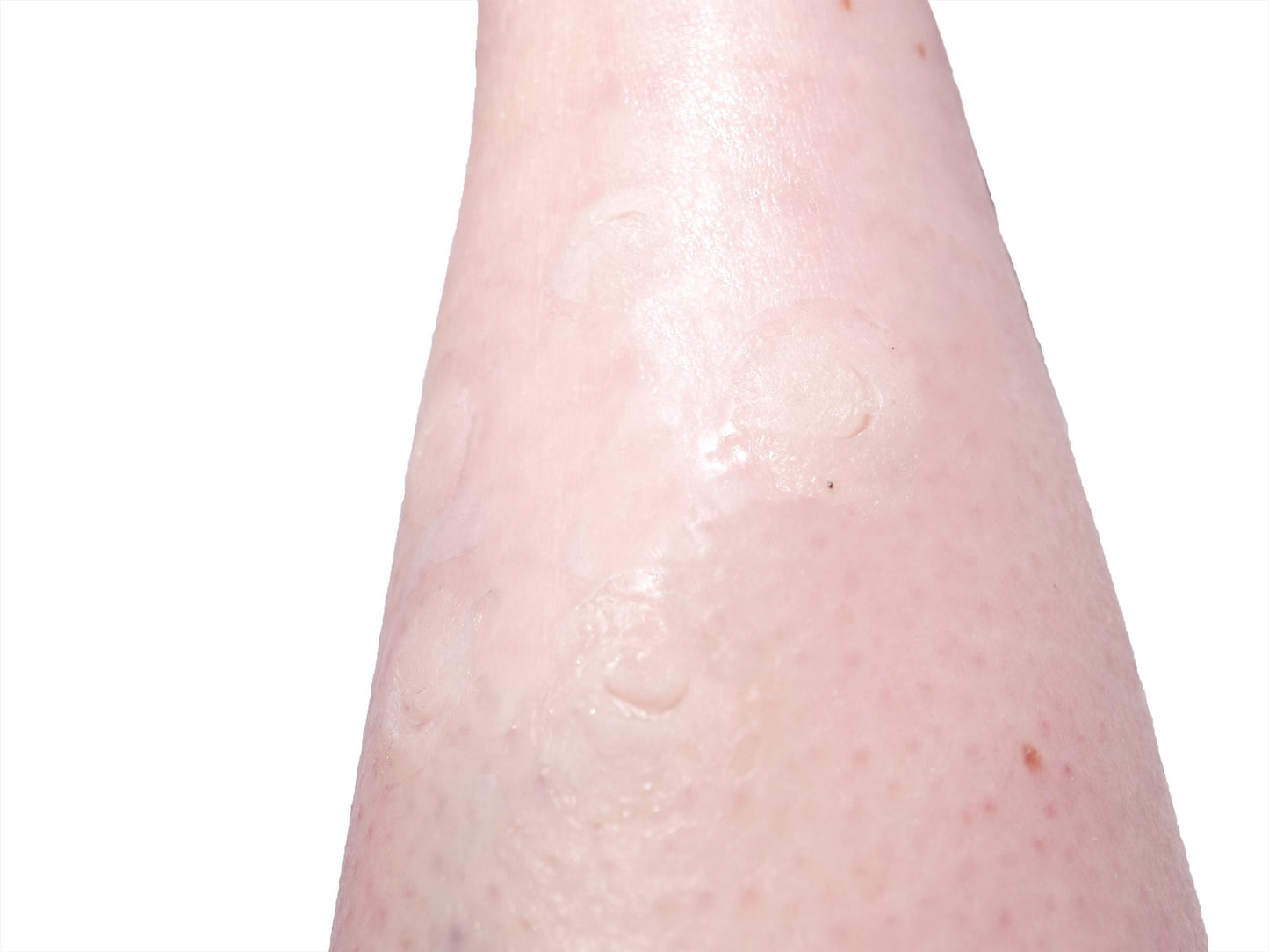 [Item 034: Grasp Residue C-7] – Laceration Cluster: Fingernail Pattern