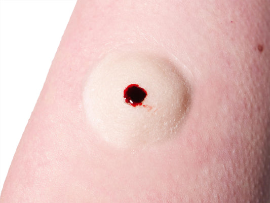[Item 035: Bio-Lesion 5-G] – Giant Subdermal Pustule Simulation