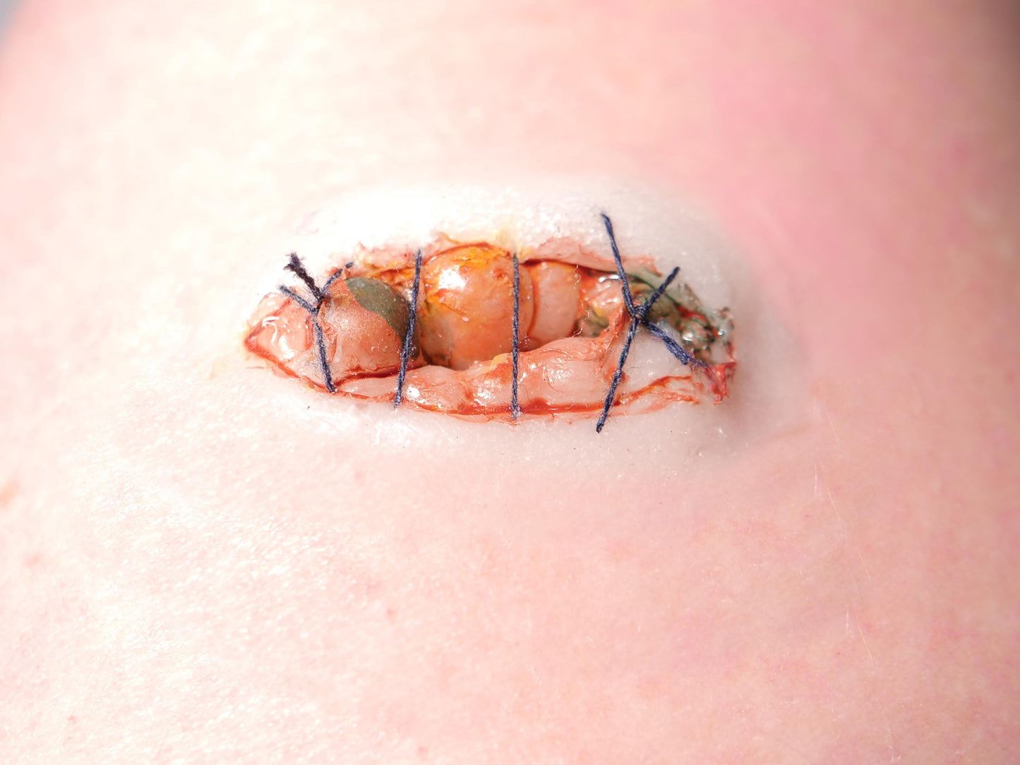 [Item 026: Ocular Suture 9-X] – Sewn Eye Socket Trauma Prosthetic