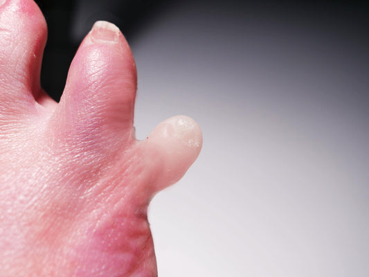 [Item 039: Digit 5-A] — Reattached Little Toe Prosthetic (Encapsulated Silicone)