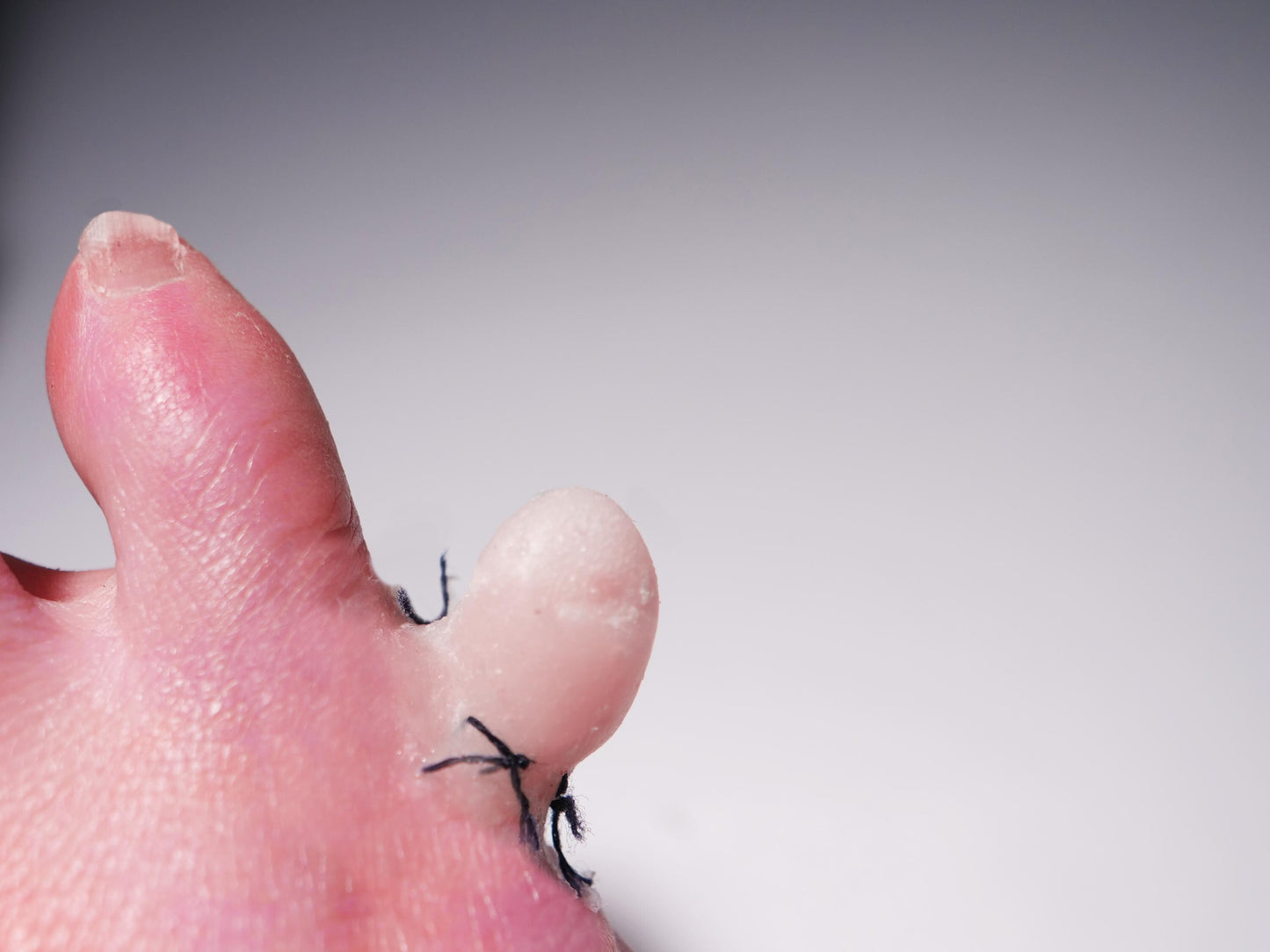 [Item 027: Digit 5-A] — Reattached Little Toe Prosthetic (Encapsulated Silicone)