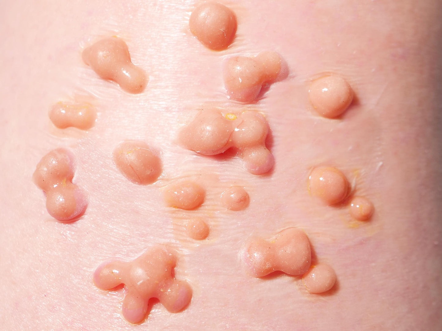 [Item 008: Dermal Bloom] – Cluster B6 Infection Prototype