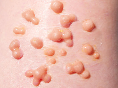 [Item 008: Dermal Bloom] – Cluster B6 Infection Prototype