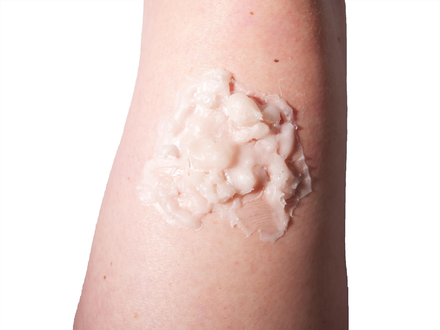 [Item 033: Dermal Failure Z-3] – Thermal Compromise Zone