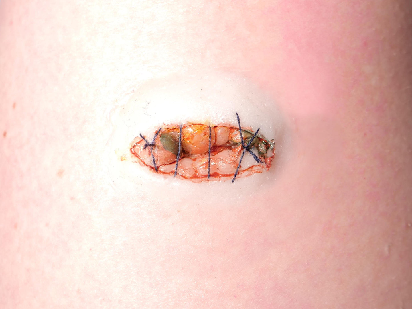 [Item 026: Ocular Suture 9-X] – Sewn Eye Socket Trauma Prosthetic